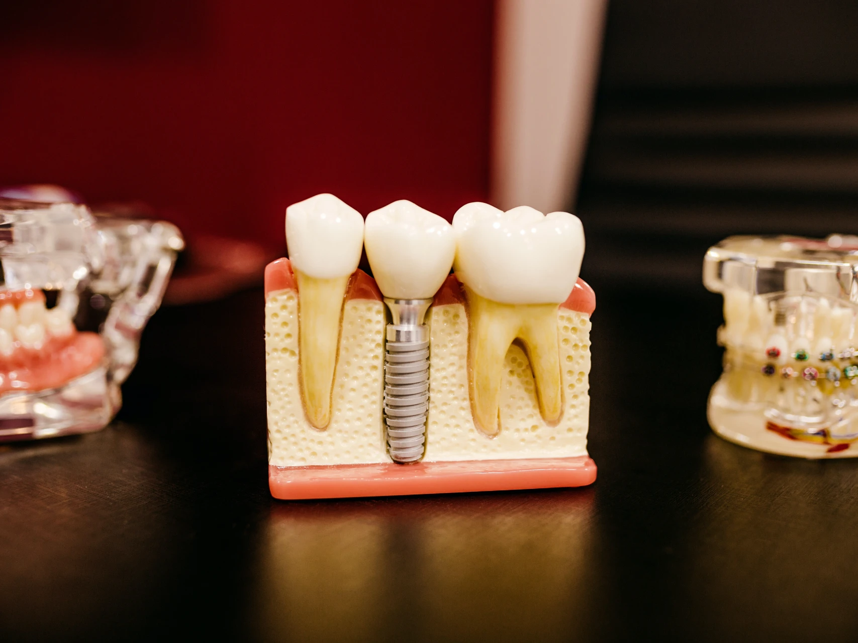 model of a single tooth dental implant | cost of dental implants in Tacoma, WA