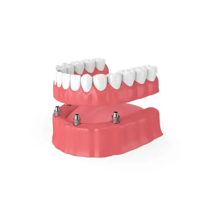 snap-in implant dentures Tacoma, WA