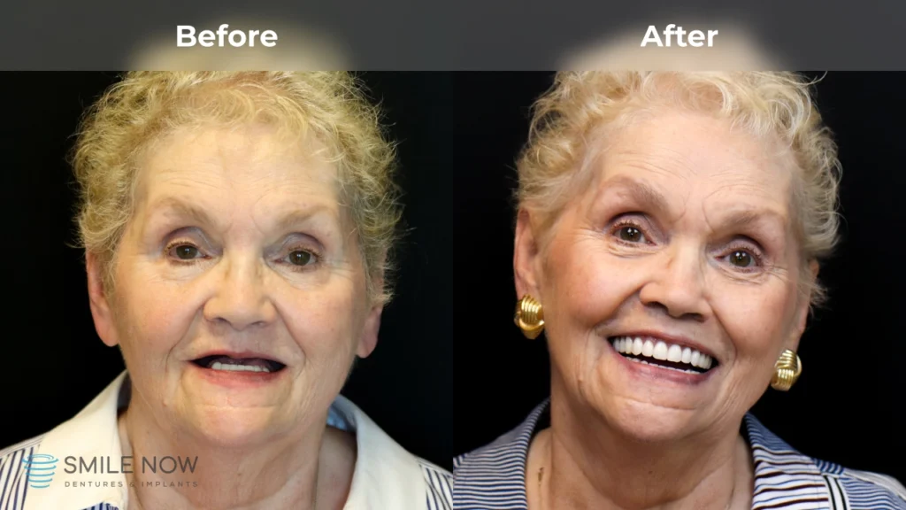 Before and after dental implants in Tacoma, WA at Smile Now Tacoma Dentures and Implants