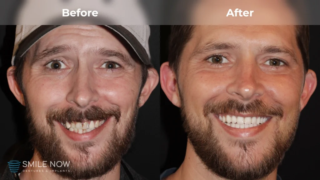 Before and after dental implants in Tacoma, WA at Smile Now Tacoma Dentures and Implants
