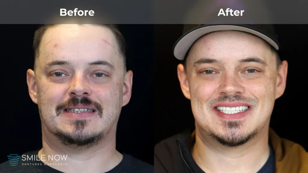 Before and after dental implants in Tacoma, WA at Smile Now Tacoma Dentures and Implants