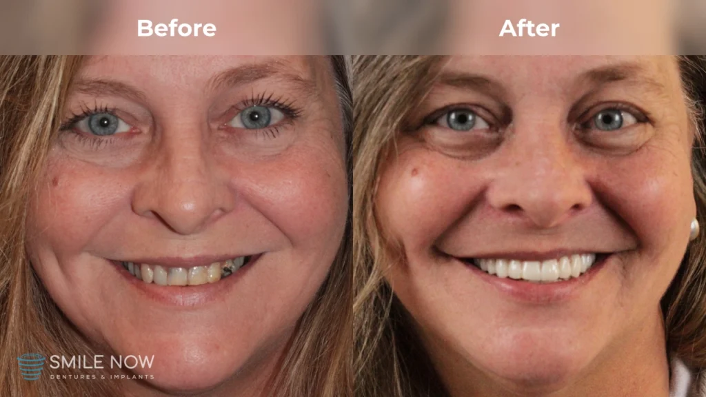Before and after dental implants in Tacoma, WA at Smile Now Tacoma Dentures and Implants