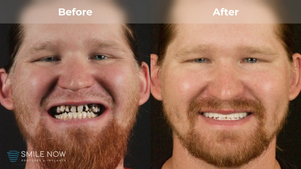 Before and after dental implants in Tacoma, WA at Smile Now Tacoma Dentures and Implants