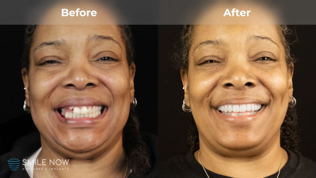 Before and after dental implants in Tacoma, WA at Smile Now Tacoma Dentures and Implants