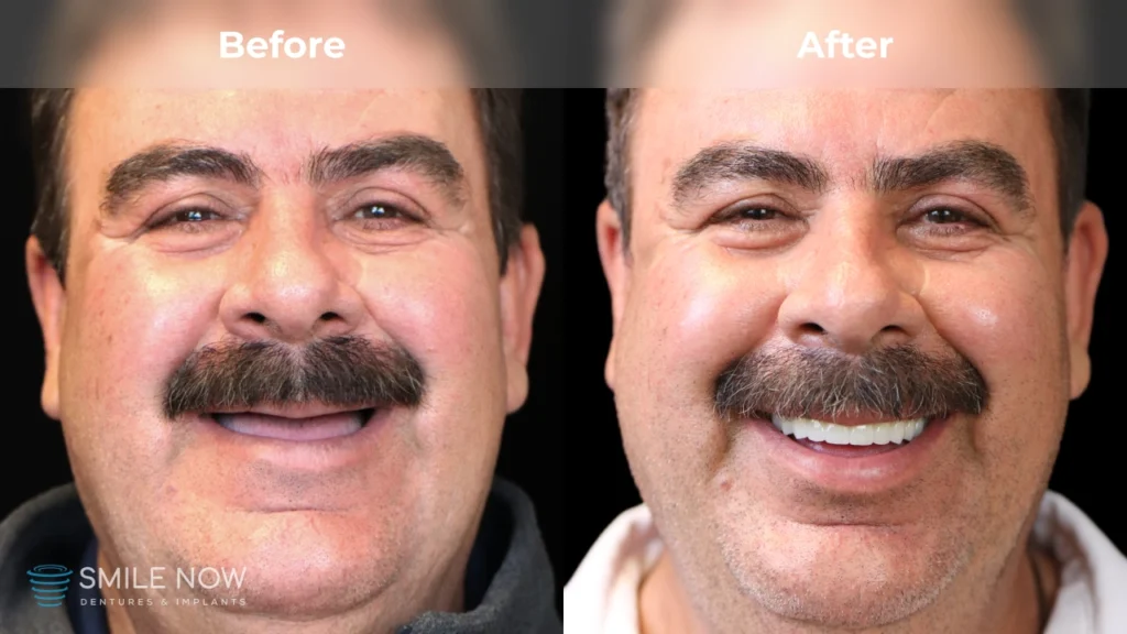 Before and after dental implants in Tacoma, WA at Smile Now Tacoma Dentures and Implants