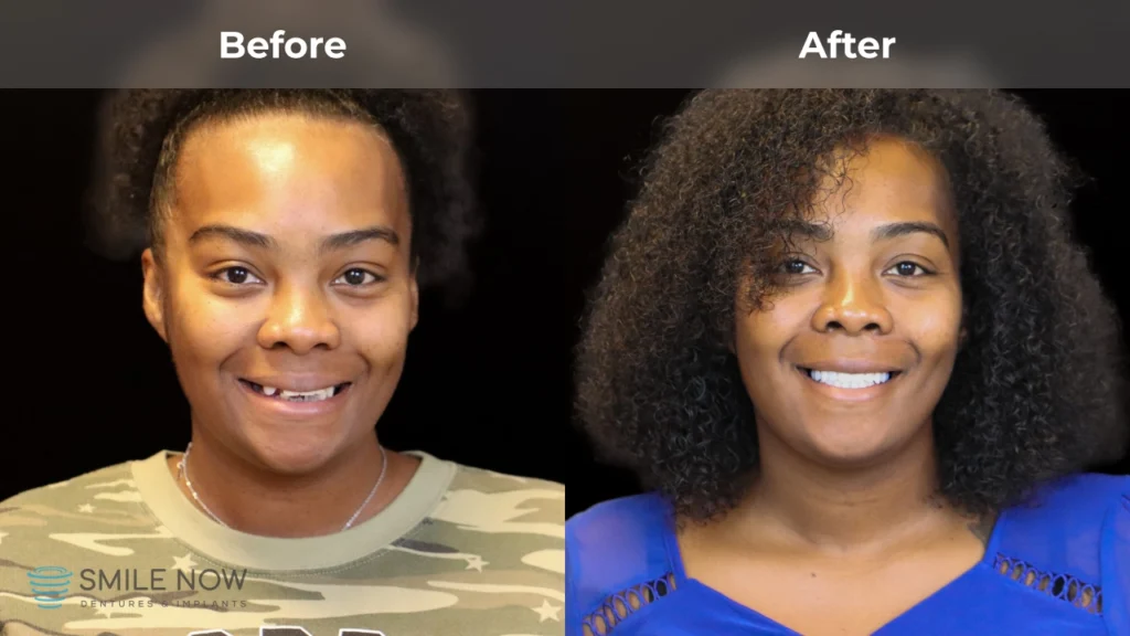 Before and after dental implants in Tacoma, WA at Smile Now Tacoma Dentures and Implants