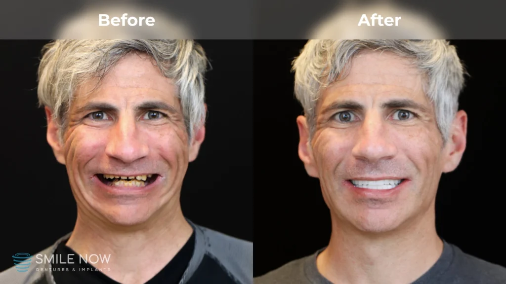 Before and after dental implants in Tacoma, WA at Smile Now Tacoma Dentures and Implants