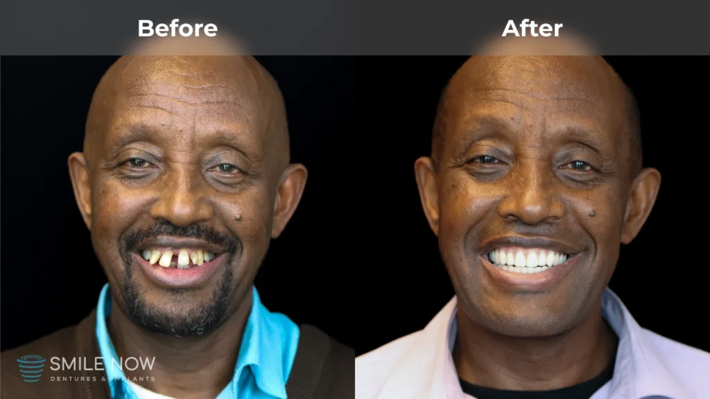 Before and after dental implants in Tacoma, WA at Smile Now Tacoma Dentures and Implants