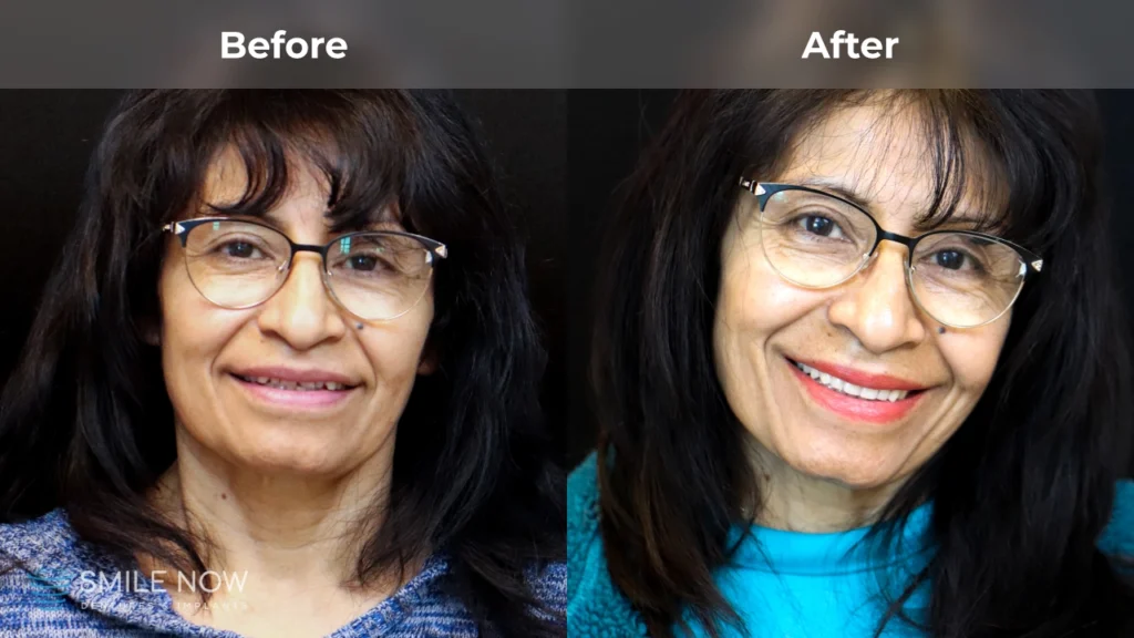 Before and after dental implants in Tacoma, WA at Smile Now Tacoma Dentures and Implants