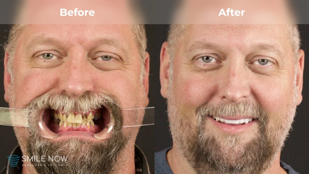 Before and after dental implants in Tacoma, WA at Smile Now Tacoma Dentures and Implants