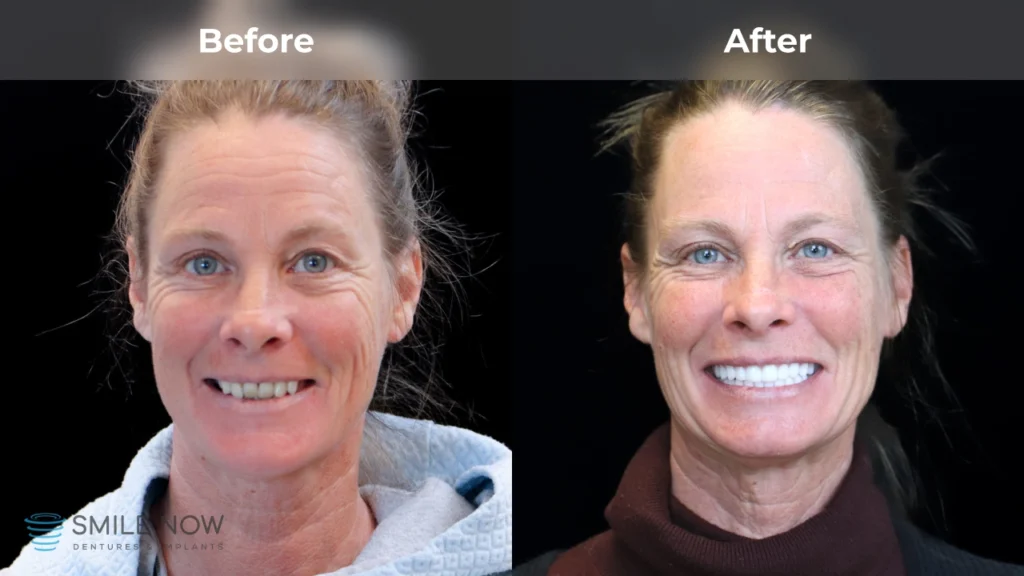 Before and after dental implants in Tacoma, WA at Smile Now Tacoma Dentures and Implants