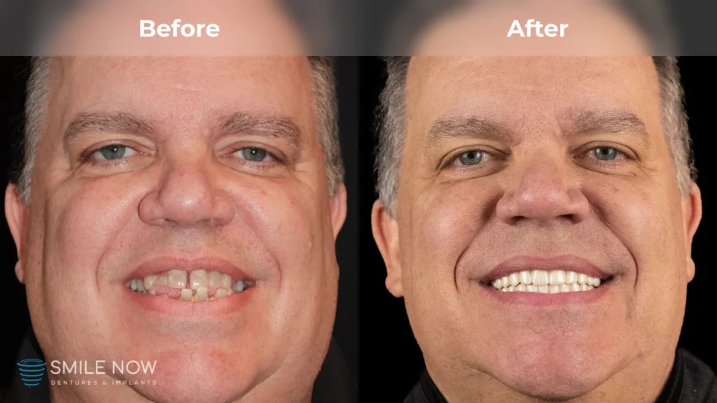 Before and after dental implants in Tacoma, WA at Smile Now Tacoma Dentures and Implants