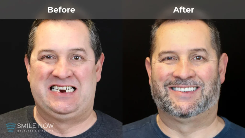 Before and after dental implants in Tacoma, WA at Smile Now Tacoma Dentures and Implants