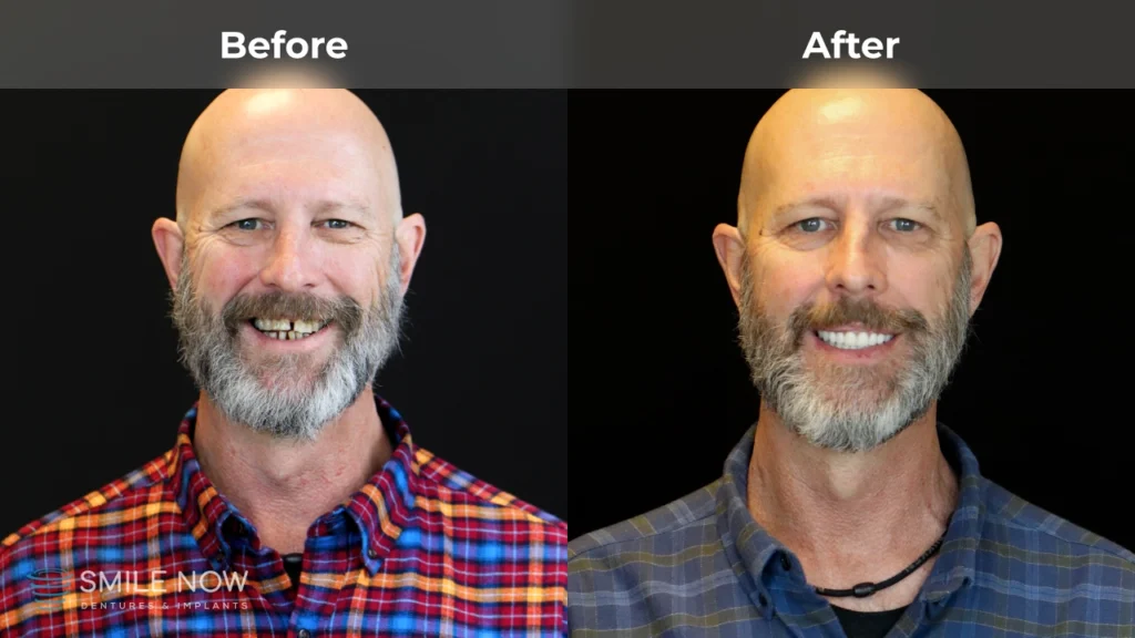 Before and after dental implants in Tacoma, WA at Smile Now Tacoma Dentures and Implants