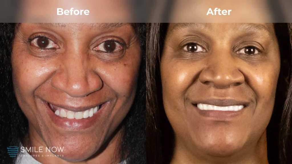 Before and after dental implants in Tacoma, WA at Smile Now Tacoma Dentures and Implants