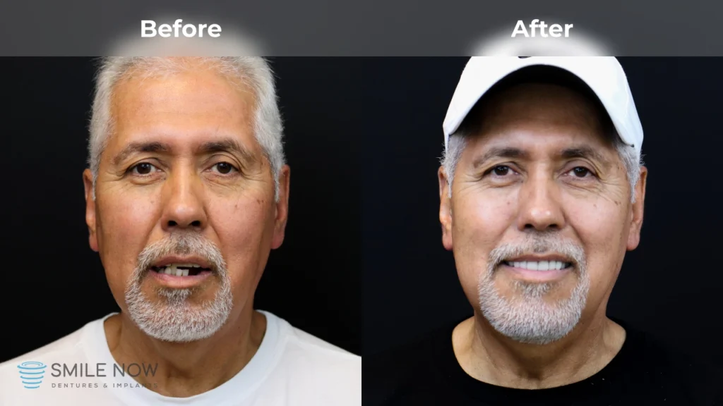 Before and after dental implants in Tacoma, WA at Smile Now Tacoma Dentures and Implants