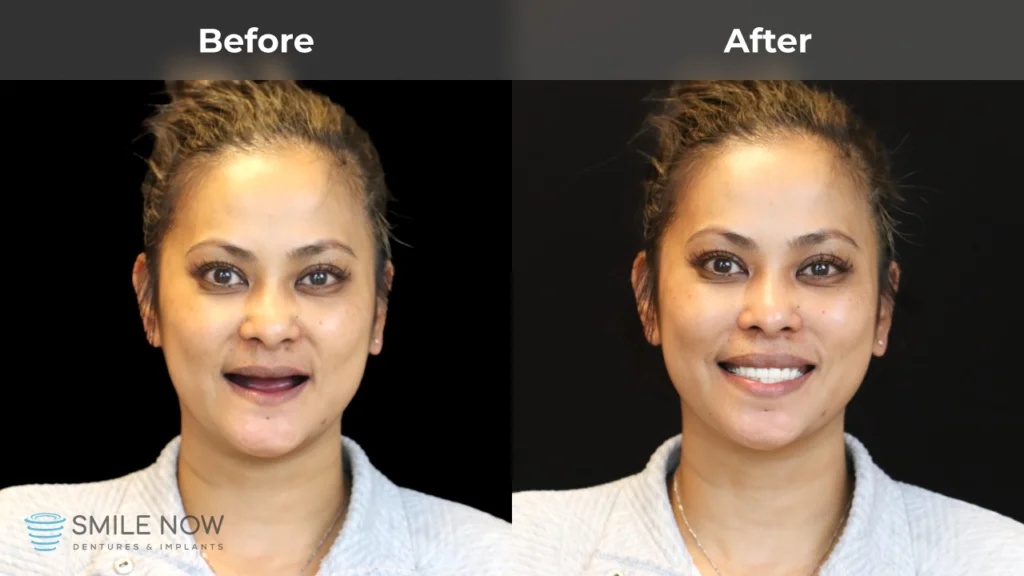 Before and after dental implants in Tacoma, WA at Smile Now Tacoma Dentures and Implants