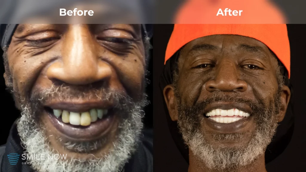 Before and after dental implants in Tacoma, WA at Smile Now Tacoma Dentures and Implants