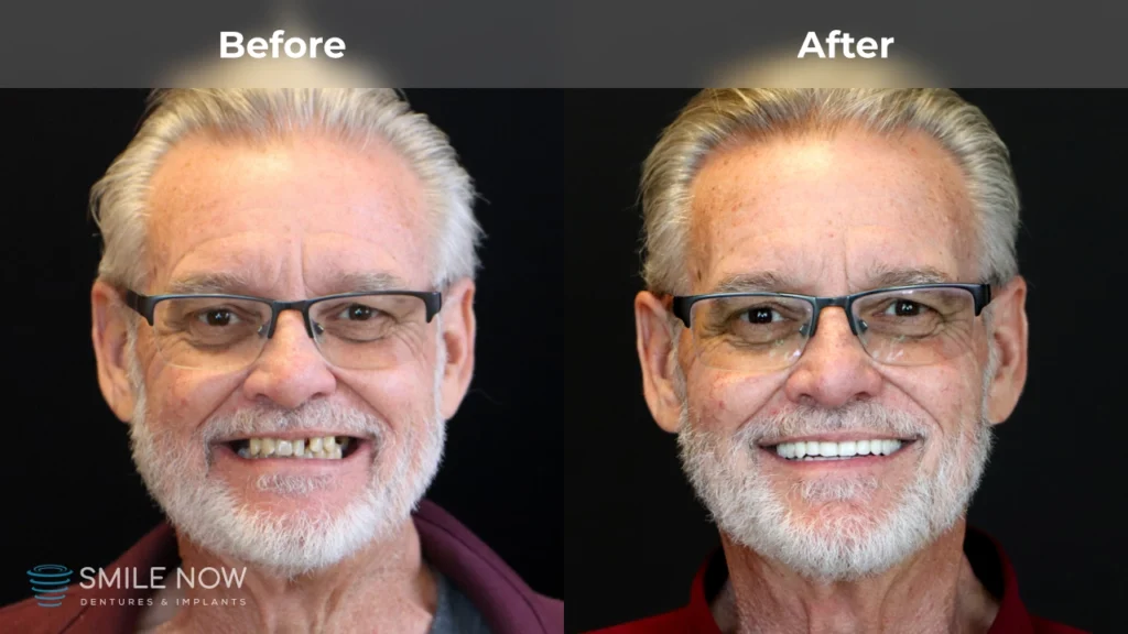 Before and after dental implants in Tacoma, WA at Smile Now Tacoma Dentures and Implants