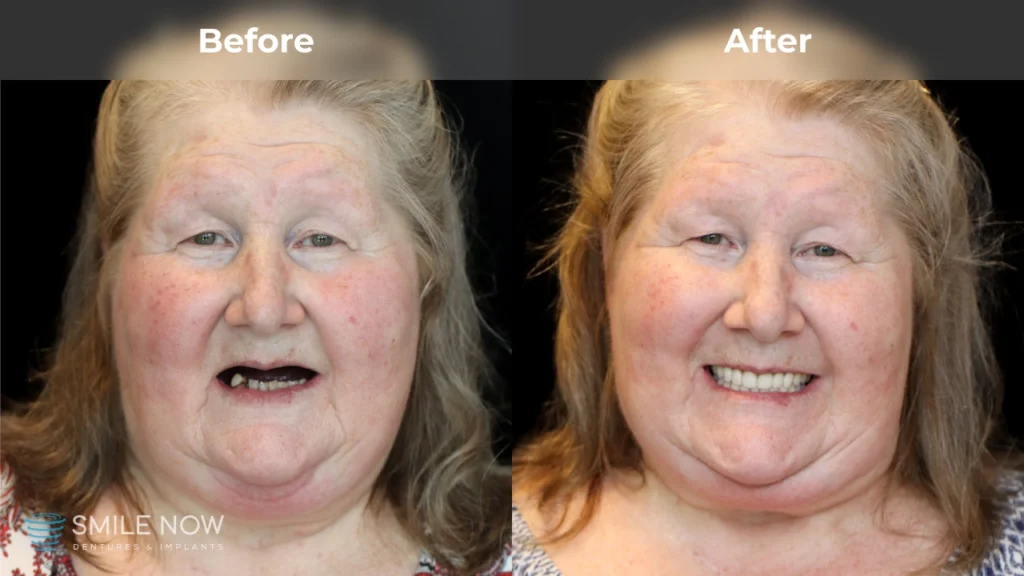 Before and after dental implants in Tacoma, WA at Smile Now Tacoma Dentures and Implants