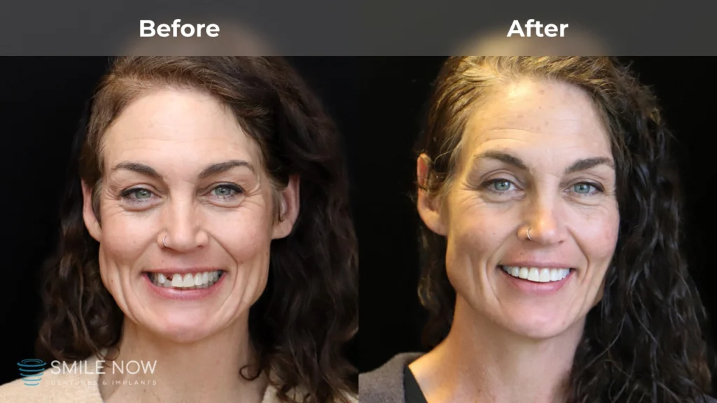 Before and after dental implants in Tacoma, WA at Smile Now Tacoma Dentures and Implants