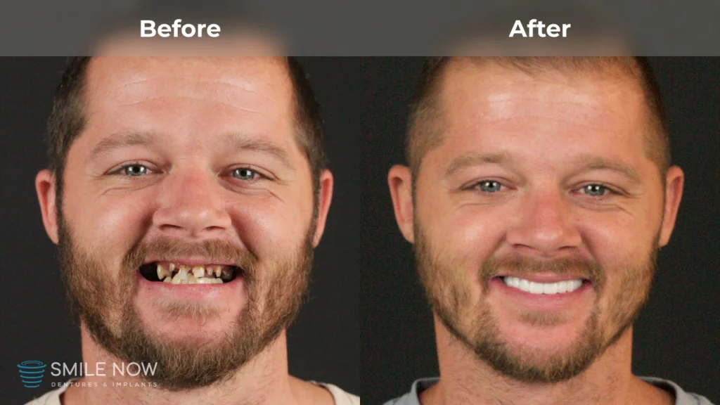 Before and after dental implants in Tacoma, WA at Smile Now Tacoma Dentures and Implants