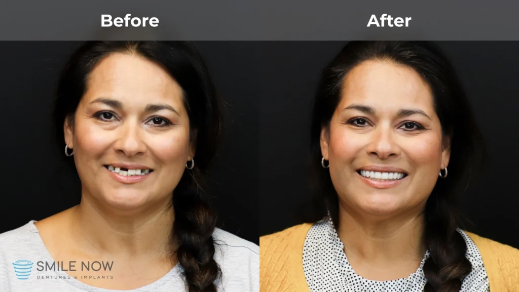 Before and after dental implants in Tacoma, WA at Smile Now Tacoma Dentures and Implants