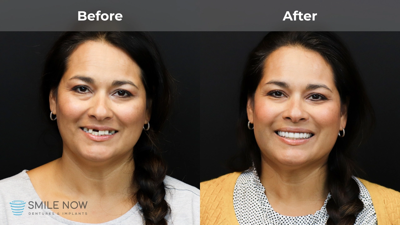 Patient before and after the All-On-6 dental implant process