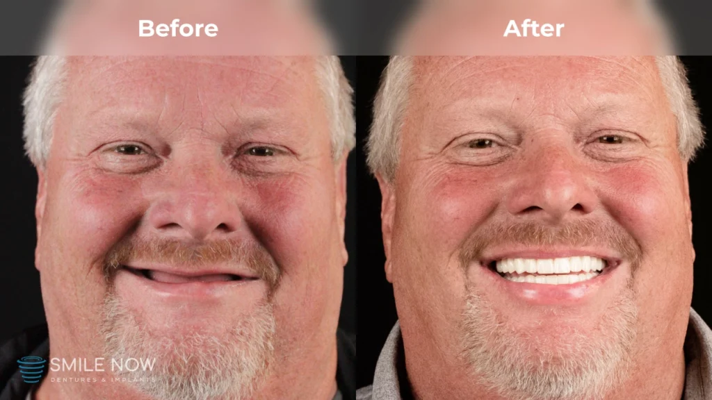 Before and after dental implants in Tacoma, WA at Smile Now Tacoma Dentures and Implants