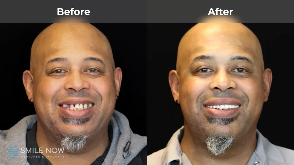 Before and after dental implants in Tacoma, WA at Smile Now Tacoma Dentures and Implants