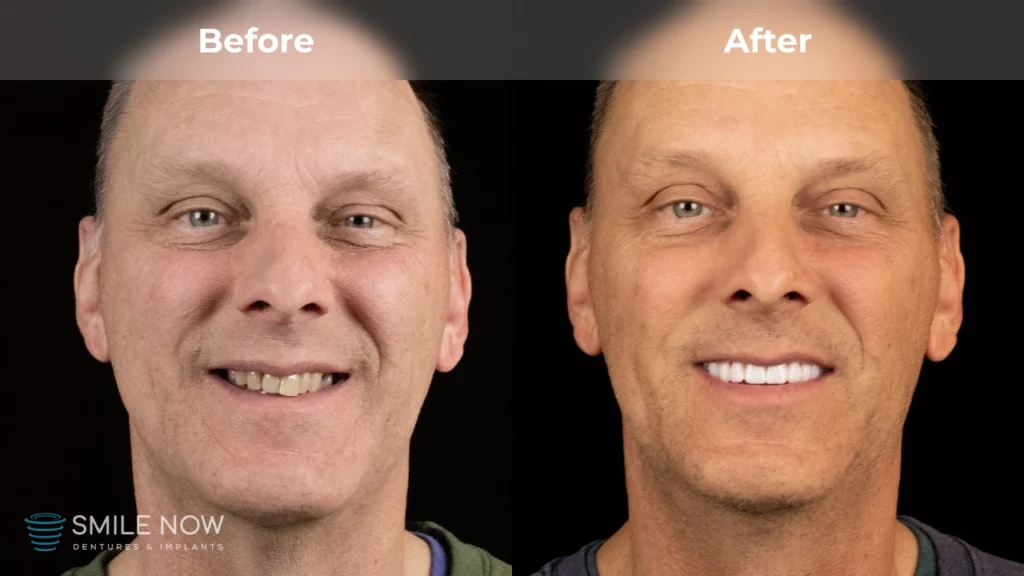 Before and after dental implants in Tacoma, WA at Smile Now Tacoma Dentures and Implants