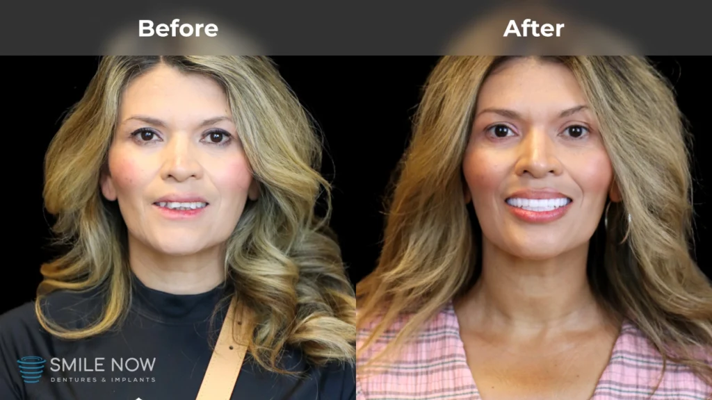 Before and after dental implants in Tacoma, WA at Smile Now Tacoma Dentures and Implants