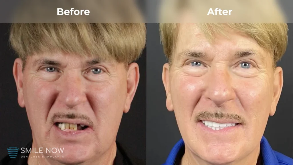 Before and after dental implants in Tacoma, WA at Smile Now Tacoma Dentures and Implants