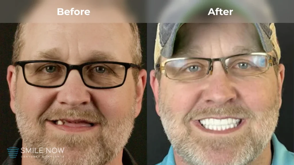 Before and after dental implants in Tacoma, WA at Smile Now Tacoma Dentures and Implants