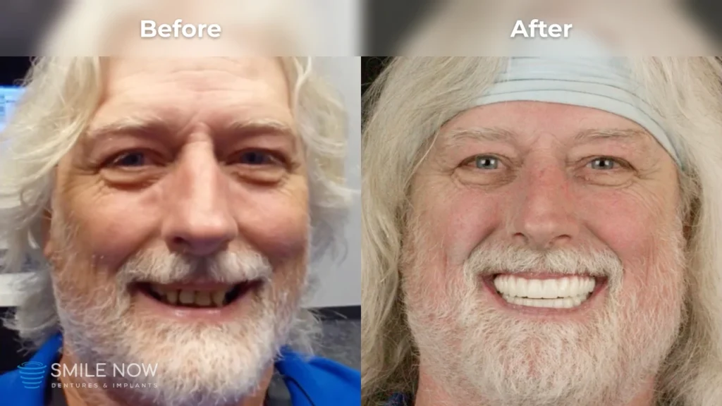 Before and after dental implants in Tacoma, WA at Smile Now Tacoma Dentures and Implants