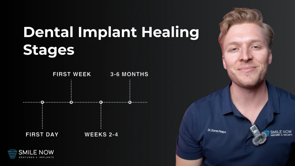 Video thumbnail for the dental implant healing stages