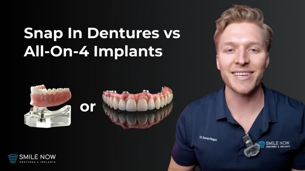 Video Thumbnail for Snap-In Dentures vs All-On-4 Dental Implants