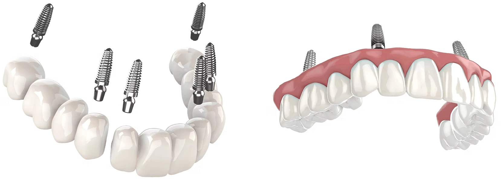 Image comparison showing 3-on-6 vs all-on-4 dental implants