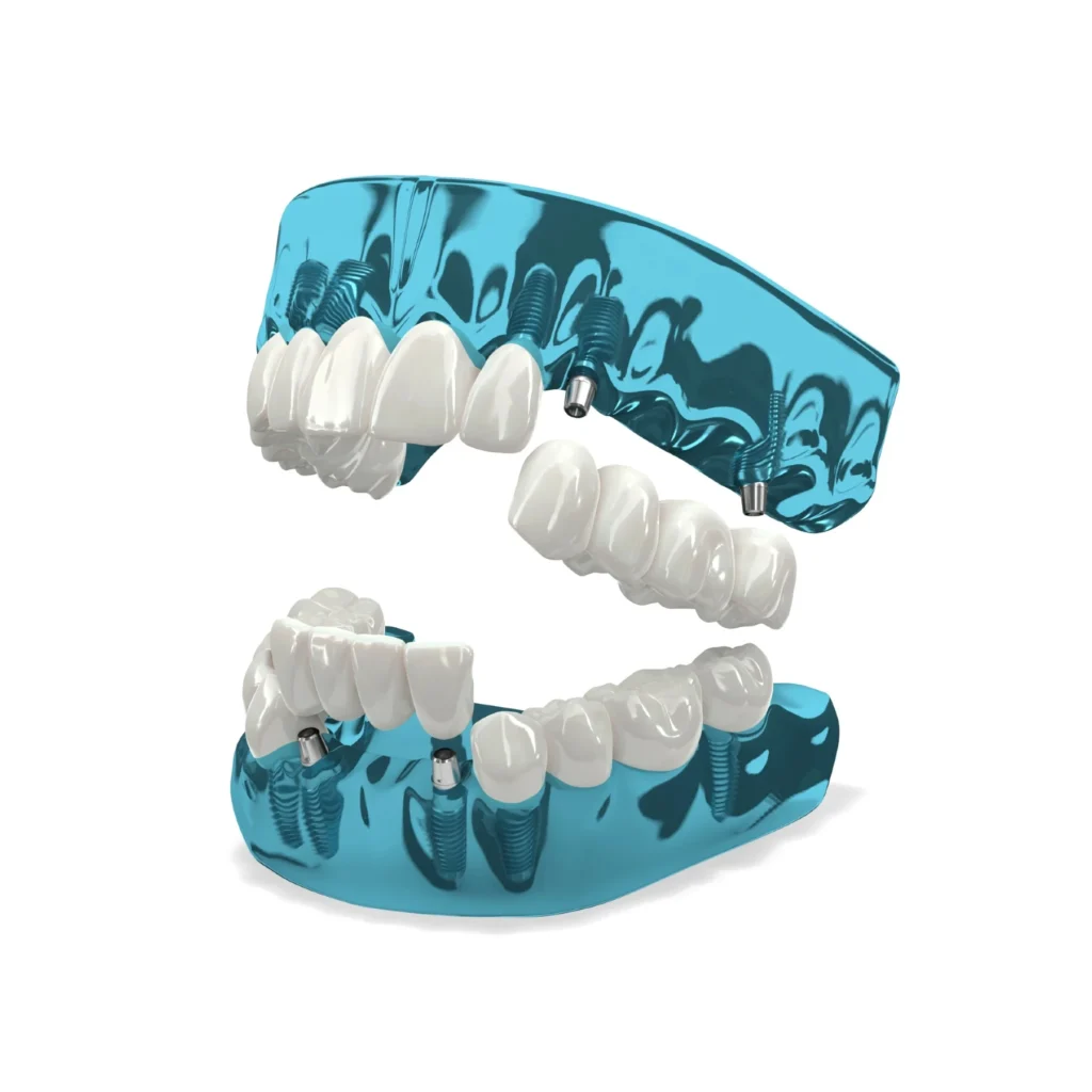 Model of 3-On-6 dental implants