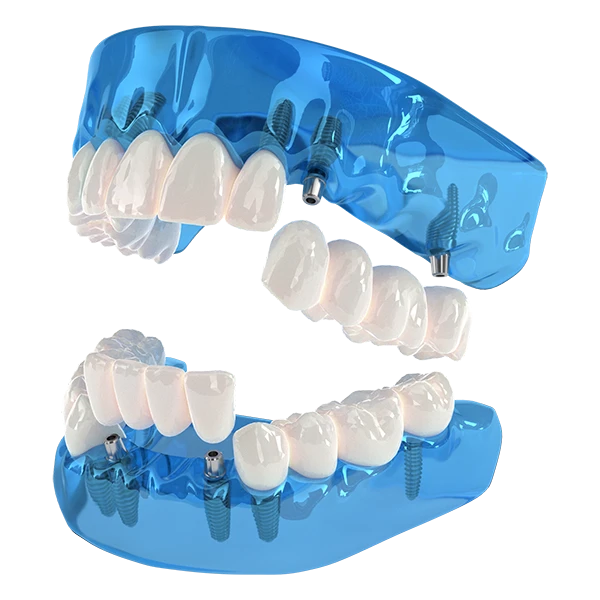 Model of 3-On-6 dental implants