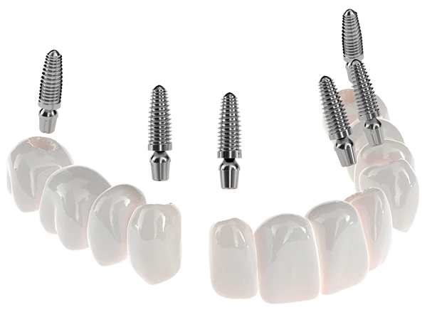 Model of 3-On-6 dental implants